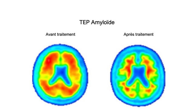 TEP amyloïde